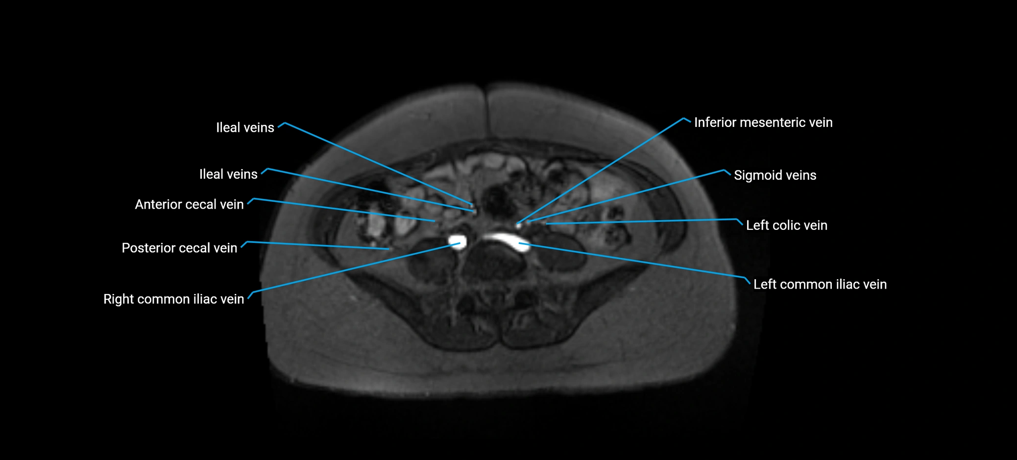 MRV abdomen pelvis & lower limb axial cross sectional anatomy labelled MRI image 123 (1).webp